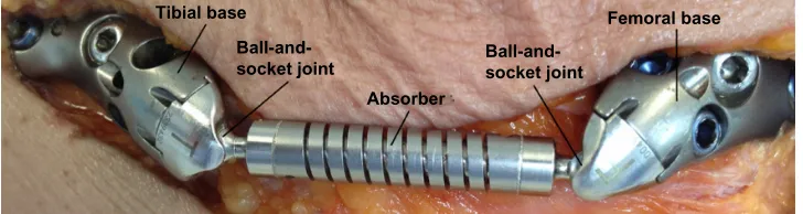 Figure 2 KineSpring system implanted on a cadaver knee (superficial layers have been resected (femoral and tibial incisions extended to meet each other above the absorber) for measurement access and visualization)