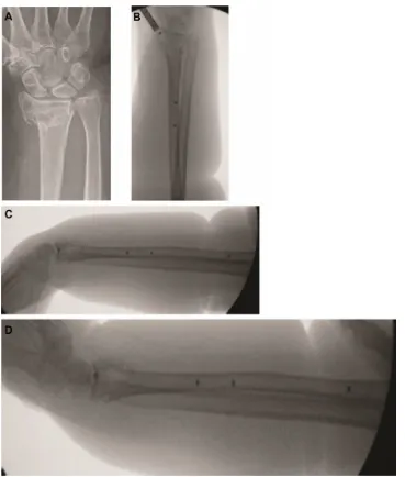 Figure 1 The PBss utilized in a distal ulna fracture.Notes: (A) Preoperative radiographs demonstrating distal ulna fracture