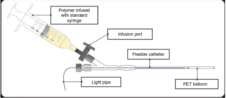 Figure 2 schematic representation of the Photodynamic Bone stabilization system.Notes: The balloon catheter is inserted into the medullary cavity of the fractured bone and the fracture stabilized