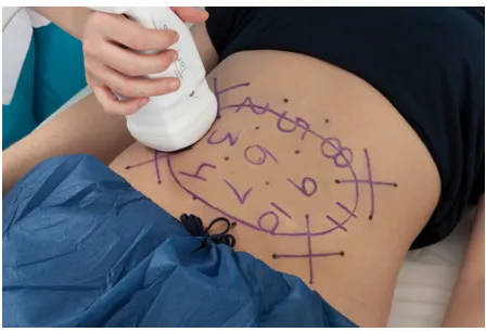 Figure 8 Liposonix™.