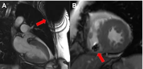 Table 1 Main modifications introduced in MRI-conditional pacing systems