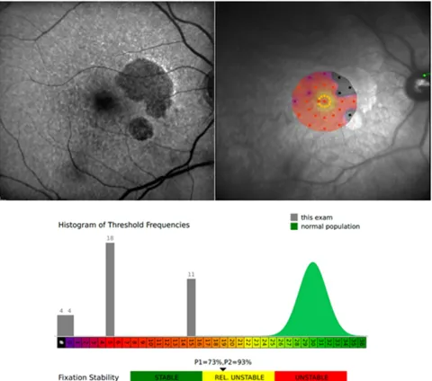 Figure 3 Autoﬂuorescence in a patient with geographic atrophy (GA) (left), Microperimetry (right), and Histogram of Macular sensitivity and Fixation stability (below) fromthe same patient