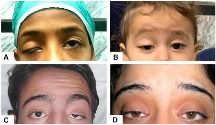 Figure 1 (A) Severe ptosis without brow elevation (group 1). (B) Brow elevation with faint forehead corrugations (group 2A)