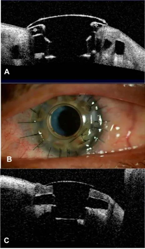 Figure 2 Patient with implanted type 1 Boston keratoprosthesis. (A) Anteriorsegment OCT showing sterile corneal melt