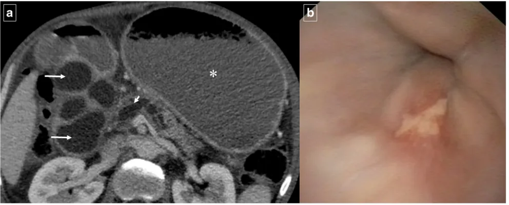 Fig. 16 A 55-year-old man with history of alcohol abuse and chronicpancreatitis. Axial contrast-enhanced CT images (a and b) demonstrateatrophy of the pancreatic parenchyma and ductal dilation (short arrow)