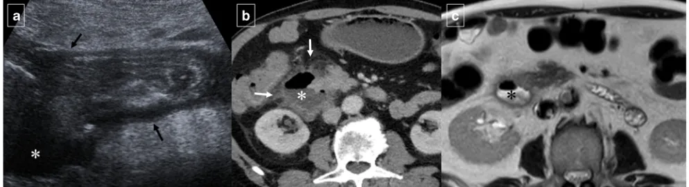Fig. 3 Duodenal diverticula indifferent patients. aAnteroposterior image from asingle-contrast uppergastrointestinal series shows atypical outpouching (*) arisingfrom descending duodenum