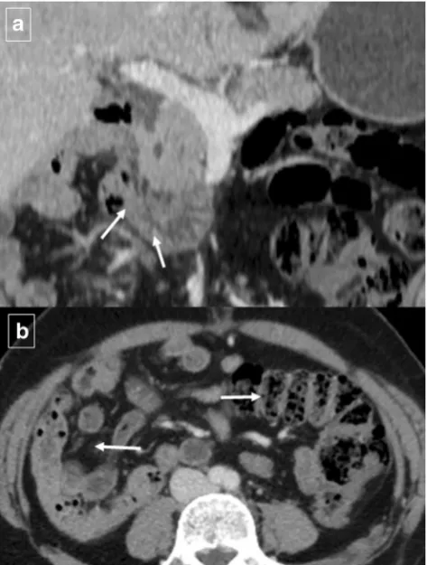 Fig. 5 Intraduodenal diverticulum in a 58-year-old woman. Single-contrast upper gastrointestinal study in the right anterior obliqueprojection shows a well-defined oval lesion (arrow) surrounded by aradiotransparent halo (“windsock” sign)