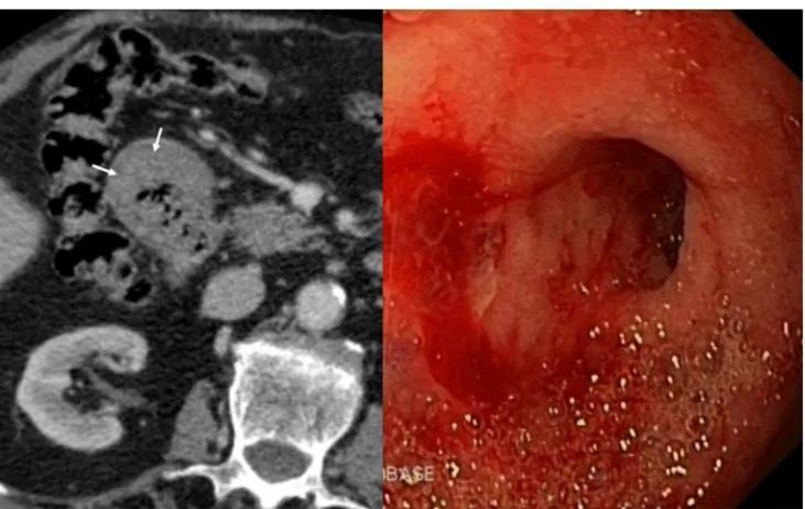 Fig. 12 A 63-year-old male smoker with upper digestive bleeding. Initialupper endoscopy showed a large bleeding ulcer on the anterior surface ofthe duodenal bulb; sclerosing therapy with adrenaline andaethoxysklerol® was unsuccessful