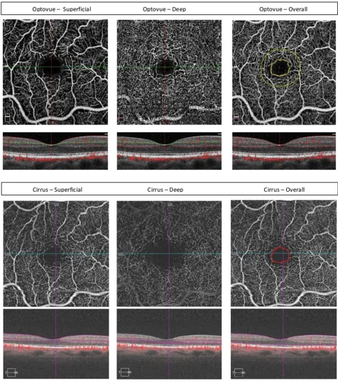 Figure 1 En face optical coherence tomography angiography image (3 x 3 mm scan) of the foveal avascular zone (FAZ) of a normal eye obtained using Optovue (top) andplexus layers showing the differences in the foveal avascular zone (FAZ) size for the segment
