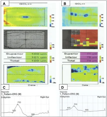 Figure 2 (A) Optical coherence tomography (OCT) of normal control:normal GCC thickness (B) OCTof chronic heavy smoker: there is reduction of GCC thickness (C)PERG of normal control: with normal amplitude and latency (D) PERG of chronic heavy smoker: with decreased amplitude and delay in latency.