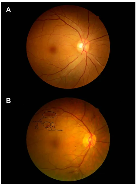 Figure 1 The fundus photos of non-DR and DR patients with T2DM.Notes: (A) The fundus photo reﬂects the normal fundus characteristics of patientswith T2DM