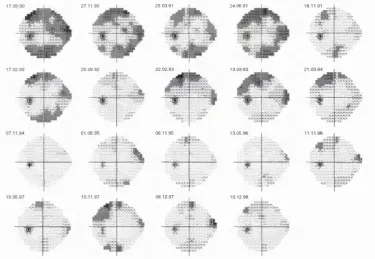 Figure 1.9 A series of visual fields showing the persistence of learning effects over a period of 8 