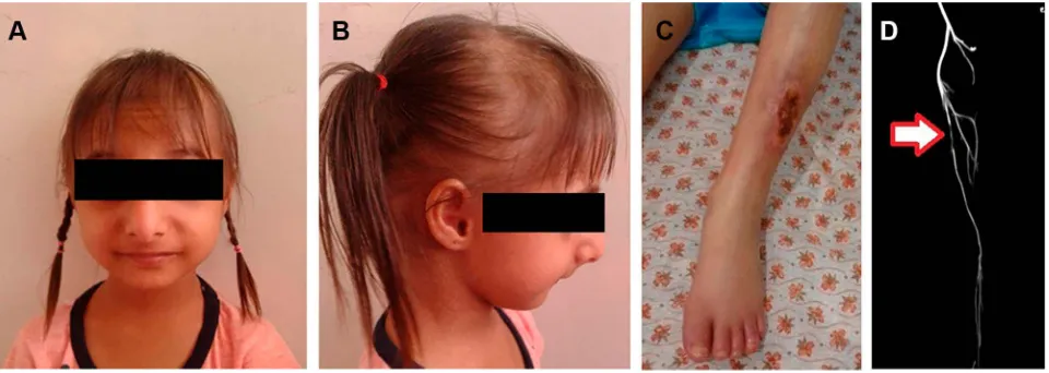 Figure 1 Bird-like face, retrognathia, microcephaly and thin hairs were prominent in frontal (The left superA) and lateral (B) views