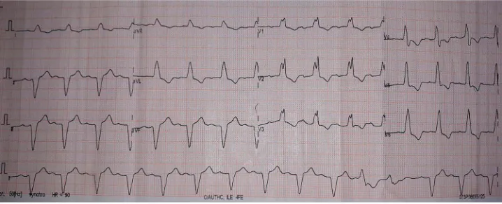 Figure 1 12 lead ECG showing MBBB precordial type. RBBB in right precordial leads, absent deep S waves in lead V5, V6 and I
