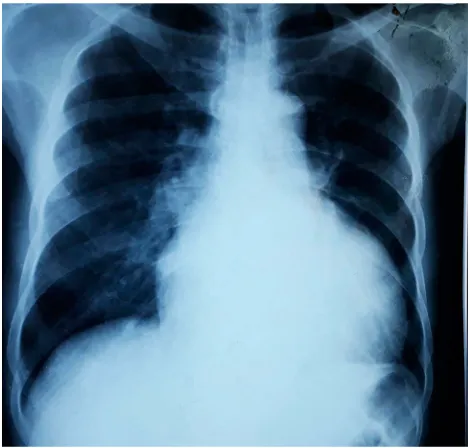 Figure 3 Parasternal long axis showing dilated left ventricle and atrium.