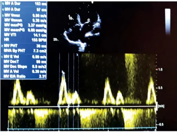 Figure 4 Parasternal long axis. Left ventricular dimension and systolic function.