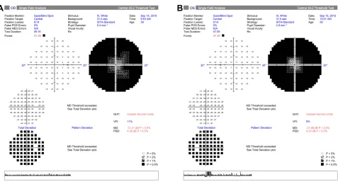 Figure 1 Visual Field Analysis. Visual ﬁeld analysis showed peripheral deep scotoma with a central residue of about 20 degrees in the right eye and 10 degrees in the left eye.