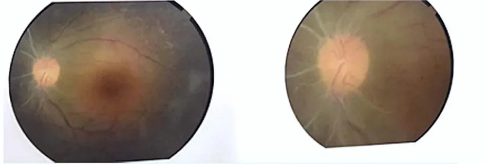 Figure 1 Color fundus photograph – right eye.