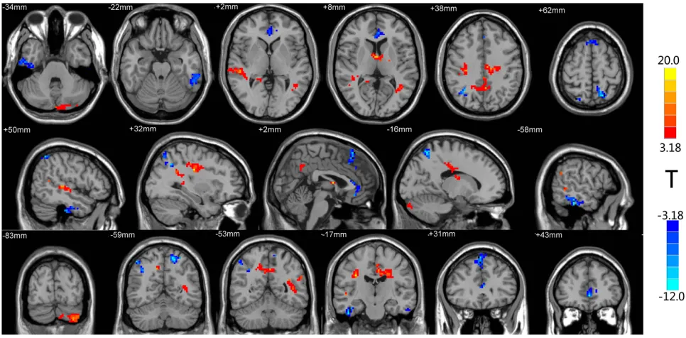 Figure 1 Brain regions with differential ReHo values after treatment. The distribution of ReHo differential brain areas in the transversal sections (upper row), sagittalsections (middle row), and coronal sections (third row) after treatment