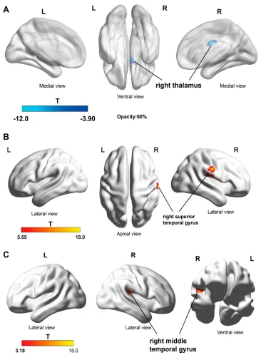 Figure 4 DKI analyses suggest brain structural changes in PHN patients after treatment