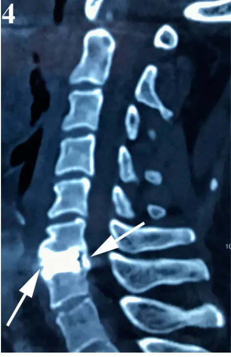 Figure 3 Plain radiographs obtained 4 years postoperatively. Lateral (surrounding the cervical disc prosthesis (arrows)