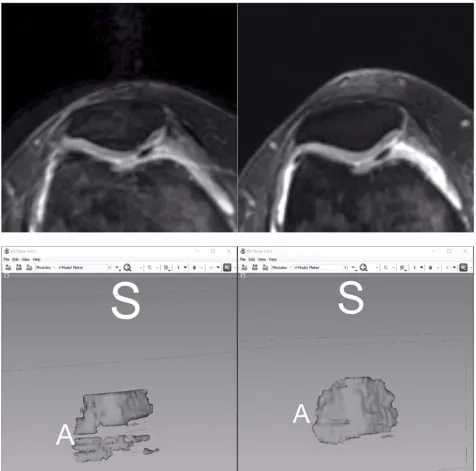 Figure 1 The patellofemoral cartilage was evaluated using 3D slicer software (a free platform for viewing and analysis of images in a software speciﬁc manner)