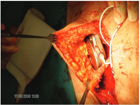 Figure 2 Subcutaneous tissue necrosis at the caudal edge of an implanted SynchroMed II pump