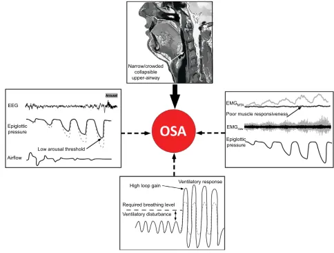 Figure 1 Schematic of the anatomical and non-anatomical causes of OSA.Notes: Some degree of anatomical vulnerability is present in OSA