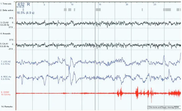 Figure 3 A 30-second epoch from a polysomnograph demonstrating the changes in REM behavior disorder