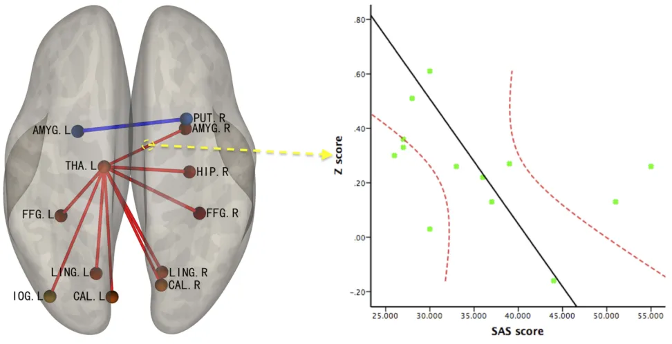 Figure 3 The result of correlation analysis between identiﬁed FCs and the score on the SAS.Abbreviations: FC, functional connectivity; THA, thalamus; AMYG, amygdala; L, Left; R, Right; SAS, Self-Rating Anxiety Scale.