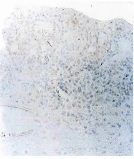 Figure 4.1a. Upper tarsal conjunctiva in VKC demonstrates cell with immunoreactivity for both CD3 (DAB) and IL-5(AEC) (arrow) and cell with immunoreactivity for only IL-5  (arrowhead) (x200).