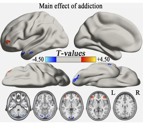Figure 1 The main effect of group (addiction) on the typical frequency band (GRF correction, voxel-levelregions with decreased VMHC, and the warm color indicates brain regions with increased VMHC