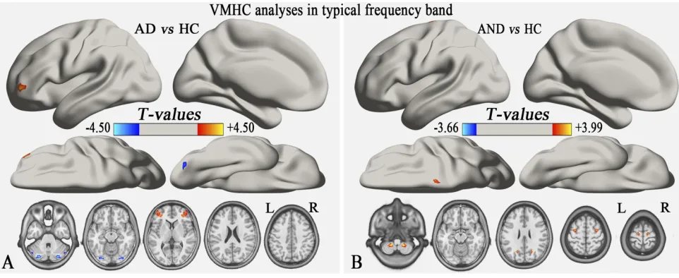 Table 2 Differences In VMHC Between The AD, AND, And HCGroups In The Typical Frequency Band