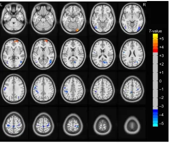 Figure 1 The main effect of group on alFF. The warm color represents a higher alFF in Pacg patients compared to Ns, whereas the cool color represents a lower alFF.Abbreviations: ALFF, amplitude of low-frequency fluctuation; L, left; NS, normal-sighted controls; PACG, primary angle-closure glaucoma; R, right.