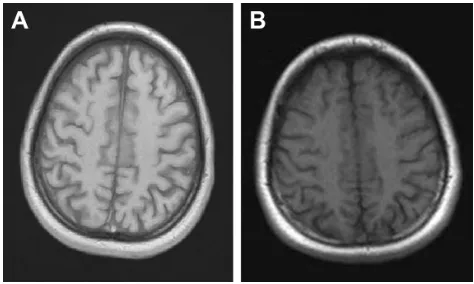 Figure 1 (A) Before the HBoT and (B) after the HBoT.Abbreviation: HBoT, hyperbaric oxygen therapy.