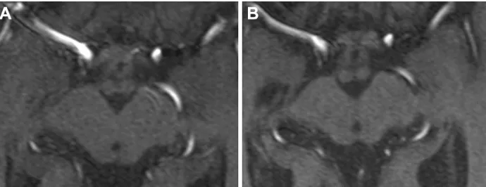 Figure 1 Multiplan reconstructions of 3D time-of-flight MRA images in transverse plane at the superior collicular level