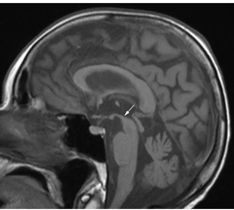 Figure 3 Transverse turbo spin-echo T2-weighted images on follow-up examination (A) at the basal ganglia and (B) at the pontine level.Note: Minor bilateral putaminal hypointensity and generalized brain atrophy are seen.