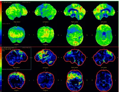 Figure 4 Brain three-dimensional stereotactic surface projection maps of positron emission tomography scans with activity maps in the top two rows and z maps showing deviation from a normal control cohort in the third and fourth rows.