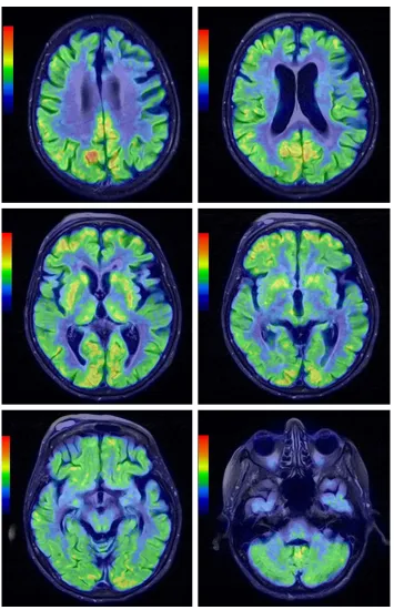Figure 5 Coregistered peT and Mr images in axial views in different levels demonstrating generalized brain atrophy, more prominent in the posterior frontal lobe, and hypometabolism of both cerebral hemispheres that was especially pronounced in the middle a