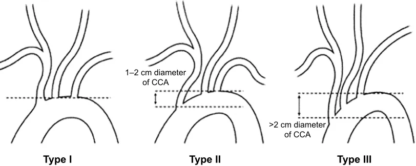 Figure 1 illustration of the three types of the aortic arch. The upper line indicates the level of the top of the aortic arch, and the dotted line indicates the level of the origin of the brachiocephalic branch.Abbreviation: cca, common carotid artery.