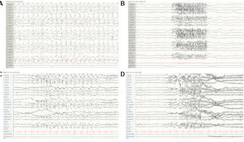 Figure 1 Electroencephalographic findings in Lennox-Gastaut syndrome.Notes: individuals with Lennox-Gastaut syndrome typically exhibit (A) generalized or diffuse slow spike and wave complexes and (B) generalized paroxysmal fast activity