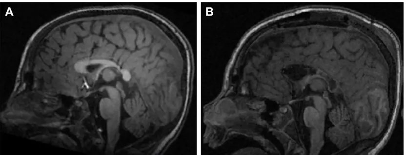 Figure 5 Complete corpus callosotomy.Note: Magnetic resonance imaging (A) before and (B) after complete corpus callosotomy in an individual with Lennox-Gastaut syndrome.