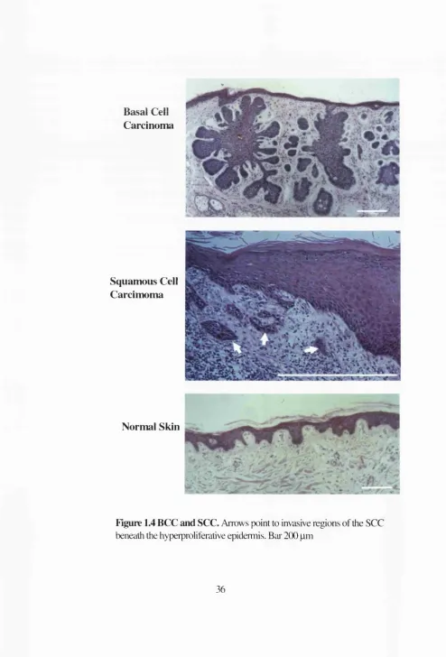 Figure 1.4 BCC and SCC. Arrows point to invasive regions of the SCC 