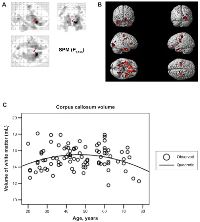 Figure 3 White matter volume changes between middle-aged adults and young adults.Notes: (A) Different brain-area perspectives, statistical parametric mapping (sPM) results: height threshold F=7.499704 (P,0.05 [FDr]), extent threshold k=20 voxels; and B) 3D