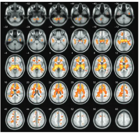Table 5 age-related white matter changes between middle-aged and old persons by voxel-based morphometry