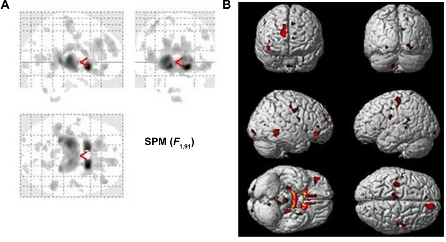 Table 6 age-related white matter changes between young and old persons by voxel-based morphometry
