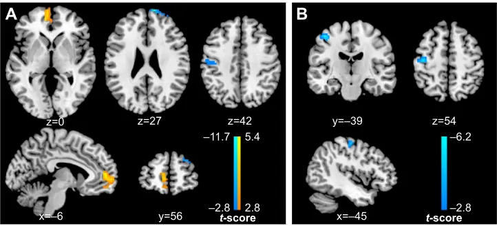 Figure S1 correlation results revealed by glM analyses for the PTsD group.Notes: in the PTsD group, PTsD symptom severity negatively correlates with brain activation in the left hippocampus (P,0.01, uncorrected) (A) and the left dlPFc (B) in the traumatic 