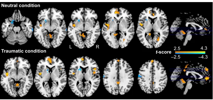 Figure 2 sD differences between the PTsD and control groups.Notes: PTsD patients show increased sD in left insula and calcarine, and decreased sD in the left Phg and right dlPFc compared with controls in the traumatic condition, as well as increased sD in the left insula, vermis and bilateral acc/vmPFc, and decreased sD in the left Pocg/Precg relative to controls in the neutral condition (P,0.05, alphasim corrected).Abbreviations: sD, standard deviation; PTsD, post-traumatic stress disorder; Phg, parahippocampal gyrus; dlPFc, dorsolateral prefrontal cortex; acc, anterior cingulate cortex; vmPFc, ventral medial prefrontal cortex; Pocg, postcentral gyrus; Precg, precentral gyrus; l, left; r, right.