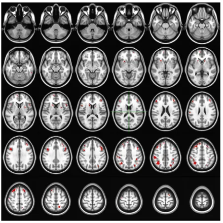 Figure 1 The brain regions showing increased glucose metabolism after levetiracetam administration in patients of the good response group (bilateral frontal, caudate nuclei, and parietal areas) assessed by sPM8.Note: Threshold: P0.005, uncorrected for extent.Abbreviation: sPM8, statistical Parametric Mapping (version 8).