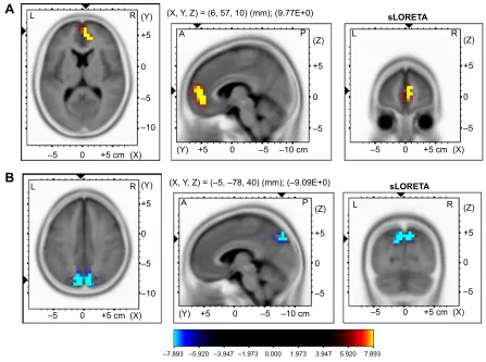 Table 3 Brain coordinates indicating regions showing significant increase (right medial frontal area) of beta1 and decrease (precuneus) of the delta relative power current density after leV administration